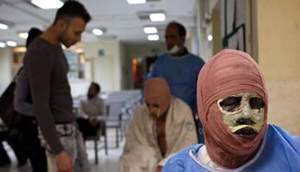 آمار سوختگی در ایران ۸ برابر میانگین جهانی است