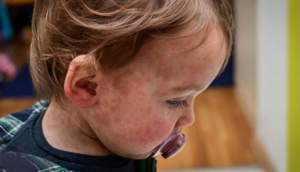 افزایش نگران‌کننده سرخک در آمریکا؛ بیشترین کودکان مبتلا واکسن نزده‌اند