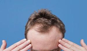 این نوع ریزش مو معمولا در مردان بسیار شایع است