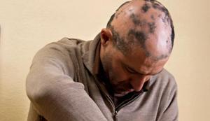 How Alopecia Areata Can Affect Your Mental Health