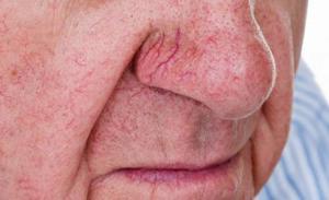 How Can I Get Rid of Spider Veins on My Face?