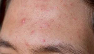 How To Avoid Sweat Pimples Year-Round