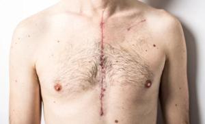 How To Care for Your Open-Heart Surgery Scar