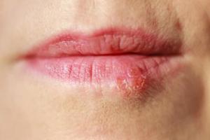 Common Cold Sore Triggers, Explained
