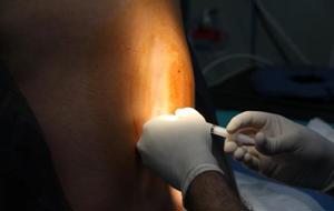 Spinal Block vs. Epidural: What Does Each Do Best?