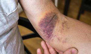 Do You Bruise Easily? 5 Reasons Why