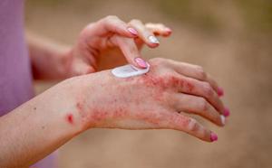Having an Eczema Flare-Up? Here’s What To Do