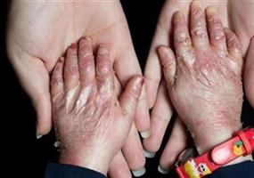 فراخوان تأمین پانسمان برای 1000 بیمار پروانه‌ای