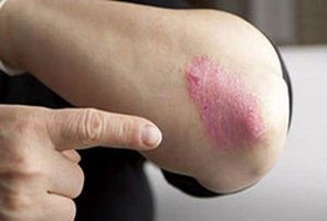 از بیماری «پسوریازیس» چه می دانید مهر