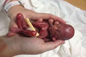 سقط جنین؛ از «صنعت پول‌های سیاه» تا عوارض جبران‌ناپذیر  ...